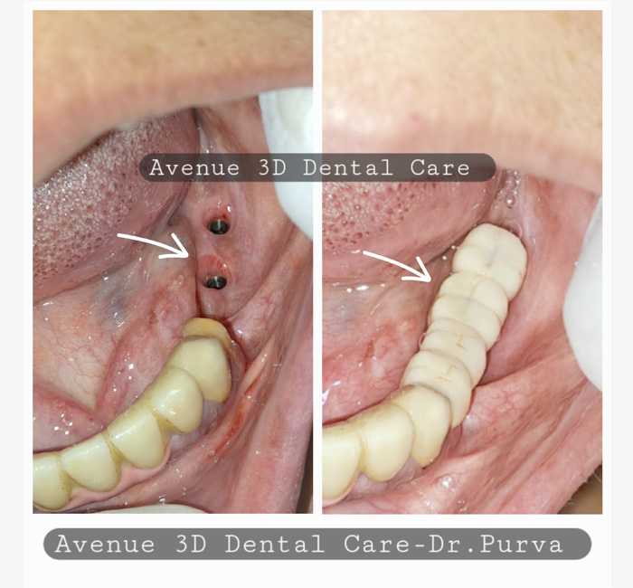 Dental Implant